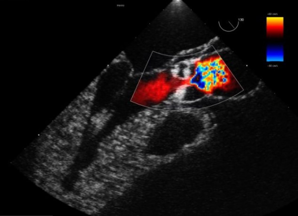 Коарктация аорты