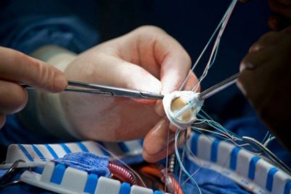 Замена аортального клапана