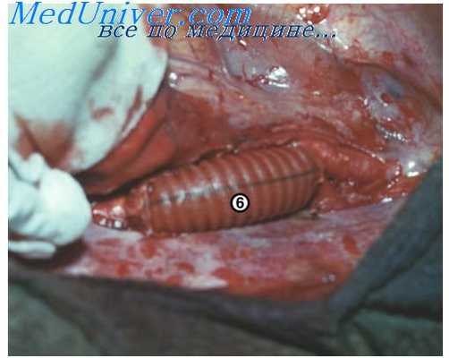 протезирование при коарктации аорты