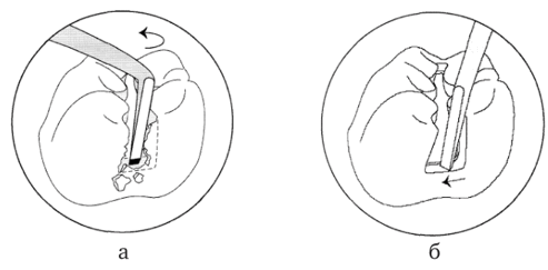 Схематичное изображения обработки кариозной полости эмалевыми ножами
