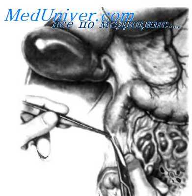 операция при инсулиноме