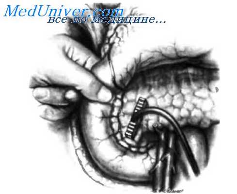 установление локализации инсулиномы