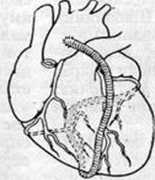 варианты множественного аорто-коронарного шунтирования: а — У-образный шунт, 6 — подковообразный, в—змеевидный