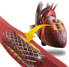 Стентирование коронарных артерий