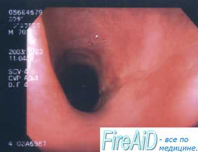 Неотложная помощь. Лечение астматического статуса 1 стадии.