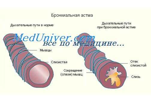 интенсивная терапия астматического статуса