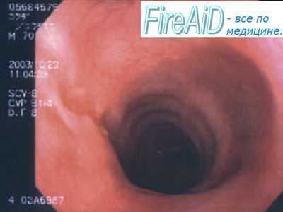 Принципы лечения астматического статуса. Лечение астматического статуса 1 стадии.