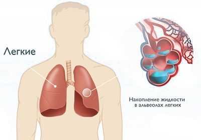 Кардиогенный шок