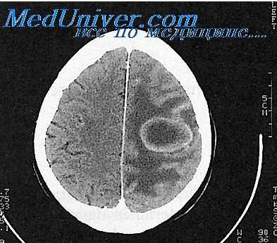 абсцесс мозга отогенный