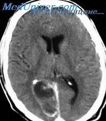 абсцесс мозга