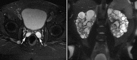  МРТ малого таза в диагностике заболеваний предстательной железы
