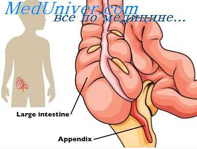 острый аппендицит