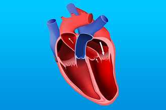 Сердечная недостаточность