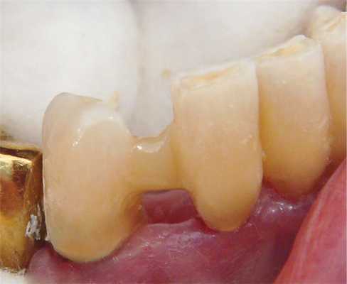 Рис. 6. Стекловолокно и оставшийся объем клиновидных дефектов покрыты слоями композита.