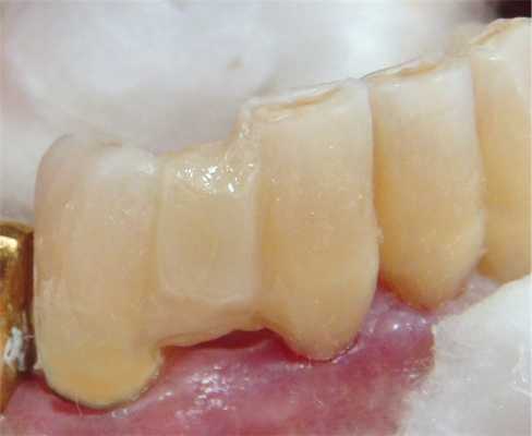 Рис. 7. Смоделирована опаковая основа 42 зуба.