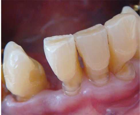 Рис. 2. Зубы после препарирования.