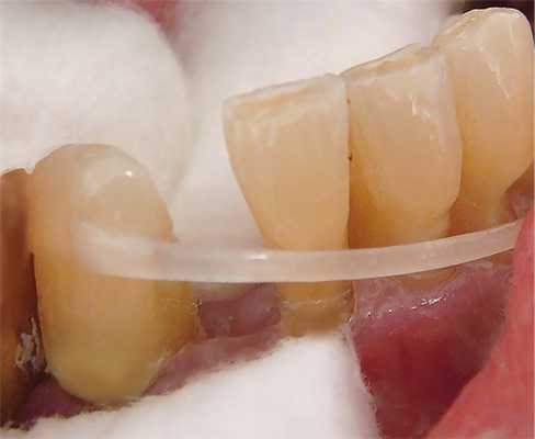 Рис. 4. Этап внесения отрезка армирующего волокна в подготовленную борозду.