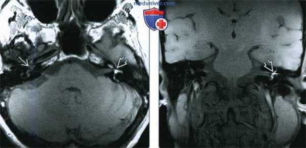 Интралабиринтное кровоизлияние (ИЛК) - лучевая диагностика
