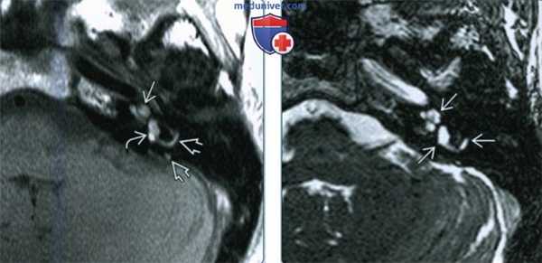 Интралабиринтное кровоизлияние (ИЛК) - лучевая диагностика