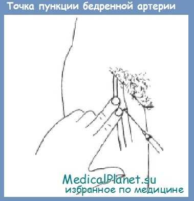точка пункции бедренной артерии