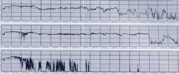 Рис. 4. Суточная рН-грамма больного К., 78 лет, с желудочно-кишечным кровотечением, история болезни №36817/03 