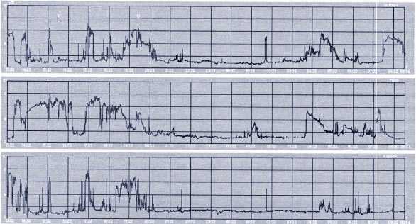 Рис. 5. рН-грамма больного К., 73 лет, с желудочно-кишечным кровотечением, история болезни № 14301/03 