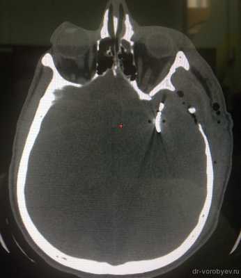 КТ в костном режиме клипс