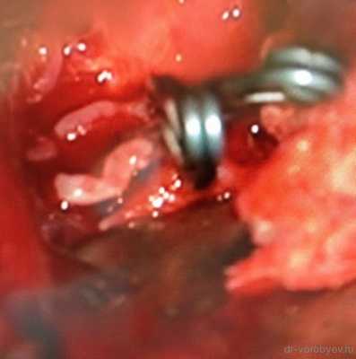 клипирована аневризма СМА