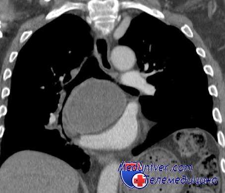 перевязка сосудов