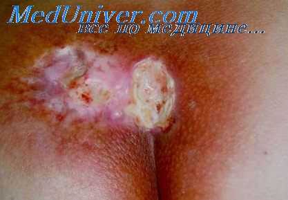 радиоактивность легких