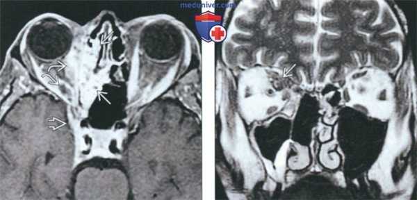 КТ, МРТ при инвазивном грибковом синусите