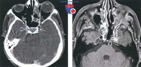 КТ, МРТ при инвазивном грибковом синусите