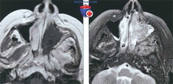 КТ, МРТ при инвазивном грибковом синусите