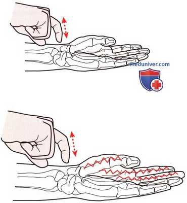 Неврологическое исследование запястья и кисти
