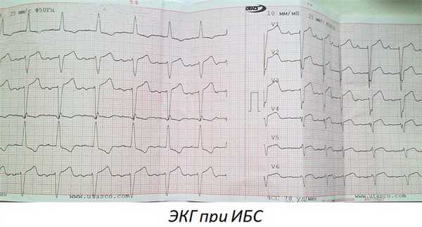 Экг при ибс