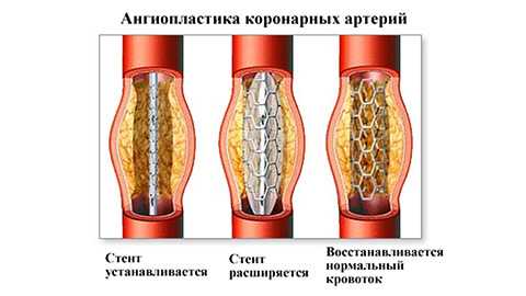 Ишемическая болезнь сердца
