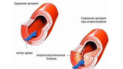 Ишемическая болезнь сердца