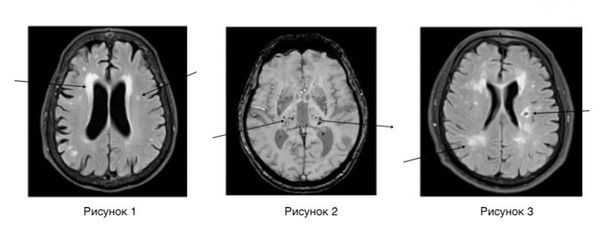 Изменения при хронической ишемии мозга на МРТ