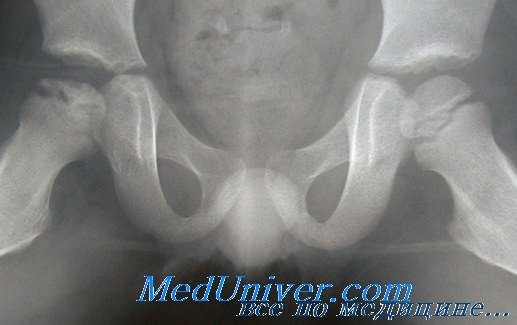 болезнь Легга-Кальве-Пертеса