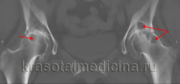 КТ тазобедренных суставов. Множественные кистовидные участки остеонекроза в головке обеих бедренных костей и в подвздошной кости слева.