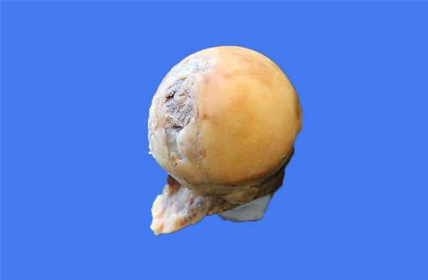 Некроз головки ТБС