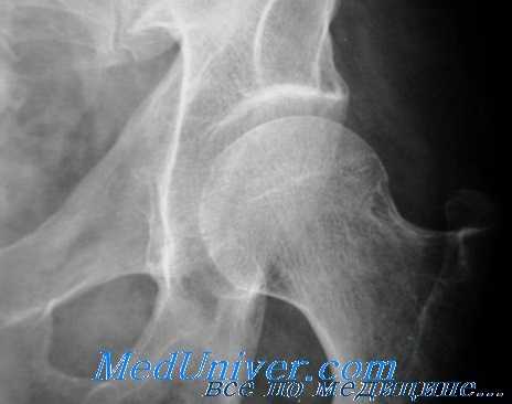 ишемический некроз головки бедра