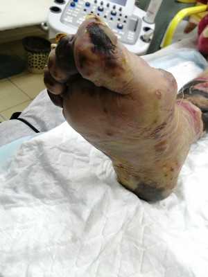 Атеросклероз, осложненный гангреной