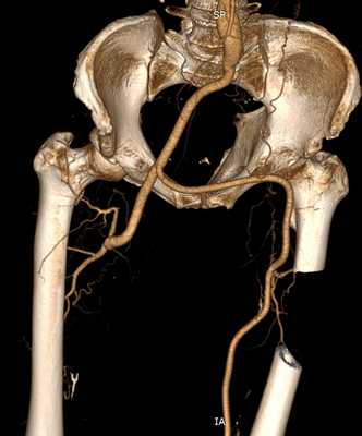Сложный шунт в обход закупоренного участка подвздошной артерии