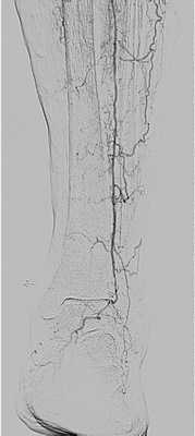 Ангиография позволяет оценить кровообращение при атеросклерозе в динамике