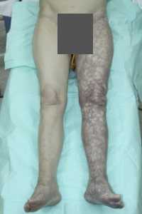 Острая ишемия левой ноги