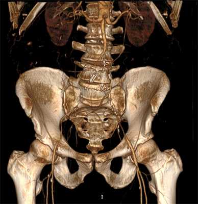 Атеросклероз нижних конечностей, окклюзия аорты