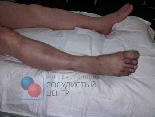 Острая ишемия правой нижней конечности при тромбозе подколенной аневризмы