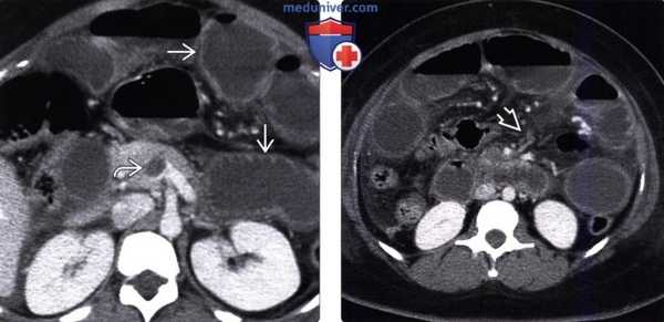 Рентгенограмма, КТ, ангиограмма при ишемическом энтерите