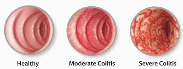 патогенез колита